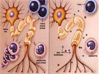 Scleroza Multipla: Demielizarea stratului de mielina