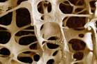 Osteoporoza este o boala scheletica sistemica